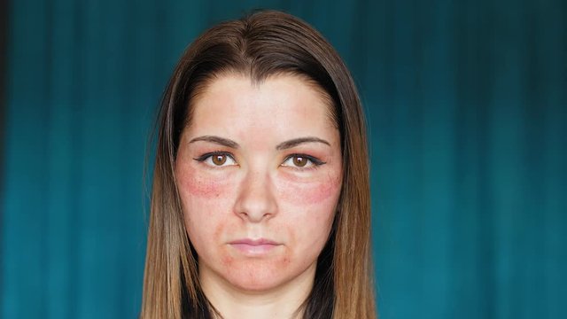 The girl with hematomas on a face. Fractional laser. Consequences of the cosmetology procedure.