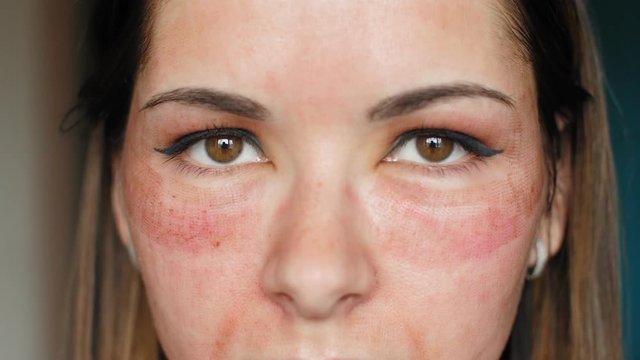 The girl with hematomas on a face. Fractional laser. Consequences of the cosmetology procedure. Face close up.