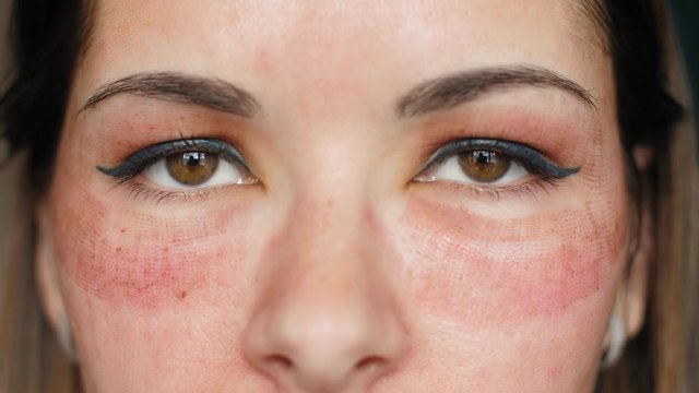 The girl with hematomas on a face. Fractional laser. Consequences of the cosmetology procedure. Face close up. Macro