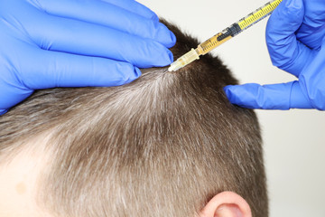 Hair mesotherapy or hair transplant: a beautician doctor makes injections in the man’s head for hair growth or to prevent baldness