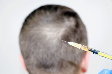Hair mesotherapy or hair transplant: a beautician doctor makes injections in the man’s head for hair growth or to prevent baldness