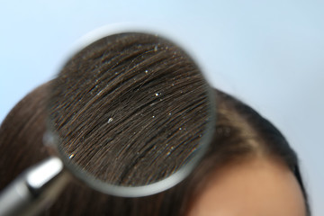 Closeup of woman with dandruff in her hair on color background, view through magnifying glass