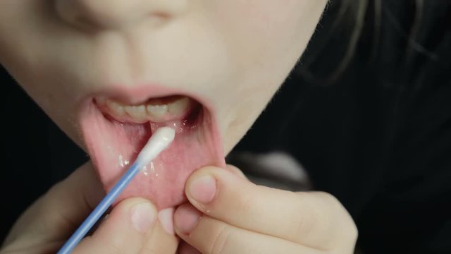 Q-tip with ointment treats herpes, a pimple in the mouth of a child girl closeup. 4K