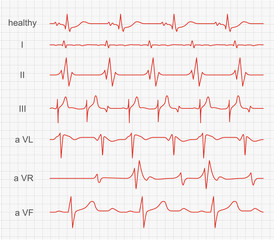 Cardiogram, heart red rhythm on monitor screen