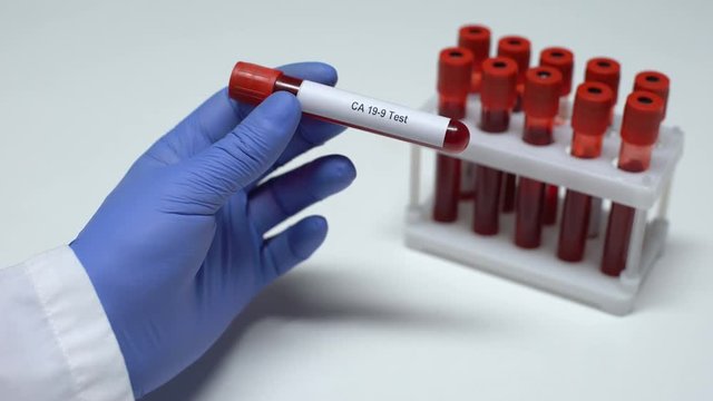 CA 19-9, doctor showing blood sample in tube, lab research, health checkup