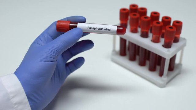 Phosphorus, doctor showing blood sample in tube, lab research, health checkup