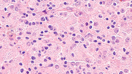 Microscopic image of disseminated histoplasmosis, a type of fungal infection caused by the fungus Histoplasma capsulatum,  The yeast forms appear as small dots within the cytoplasm of macrophages.  © David A Litman