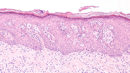 Breast Cancer Awarness: Paget's Disease of the breast (nipple) is usually associated with ductal carcinoma in situ (DCIS). Malignant cells extent into epidermis of skin, giving an eczema-like rash. - obrazy, fototapety, plakaty