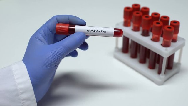 Amylase test, doctor showing blood sample in tube, lab research, health checkup