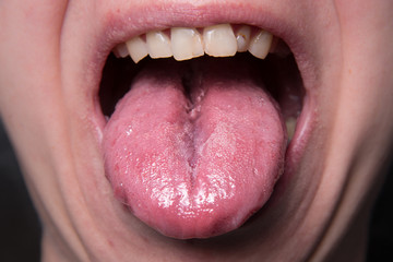 Male shows overgrowth candidiasis on his tongue