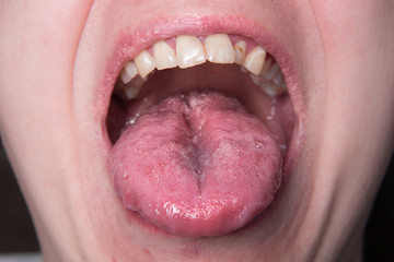 Obraz premium Male shows overgrowth candidiasis on his tongue