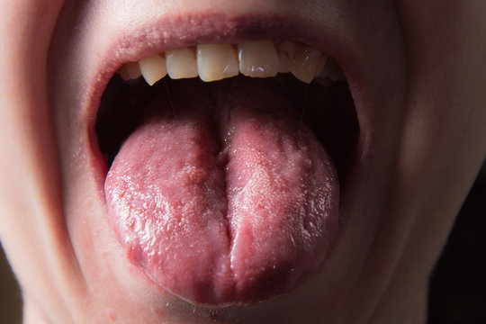 Male shows overgrowth candidiasis on his tongue