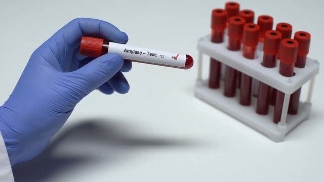 Positive Amylase test, doctor showing blood sample, lab research, health checkup