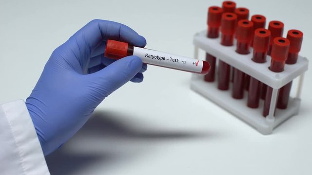 Positive Karyotype test, doctor showing blood sample in tube, health checkup