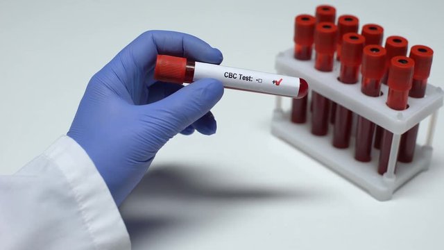 Positive CBC test, doctor showing blood sample, lab research, health checkup