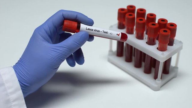 Positive Lassa virus, doctor showing blood sample, lab research, health checkup