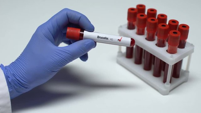 Positive Brucella test, doctor shows blood sample, lab research, health checkup