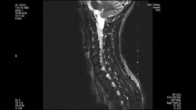 MRI scans, lumbar spine closeup