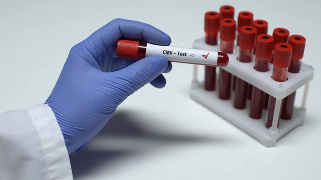 Positive CMV test, doctor showing blood sample, lab research, health checkup