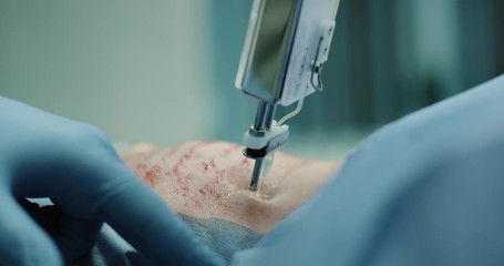 Closeup skin care in a modern clinic new invention of prp or vampirefacial procedure of mesotherapy , all process capturing details , micro-needling. 4k - Powered by Adobe