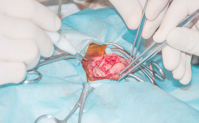 Surgery hernia ripples.