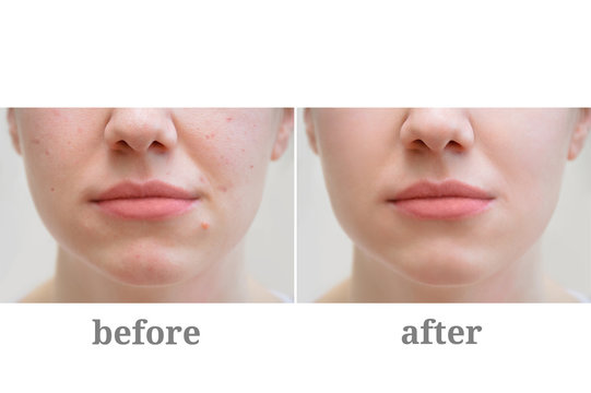 Acne on the girl's face. Treatment of rosacea. Before and after.