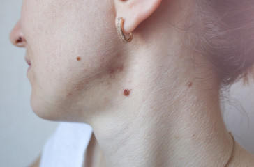 Scars and wounds on the neck after acne. Removal of birthmarks and nevus. Problems with skin.