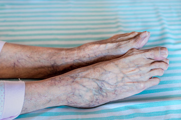 Side view of elder human feet with purple veins