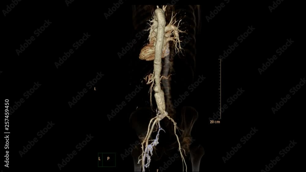 Poster cta abdominal aorta 2d , 3d rendering image and mip technique turn around on the screen 3d productio