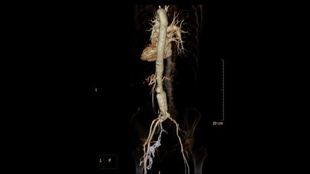 CTA abdominal aorta 2D , 3D rendering image and MIP technique turn around on the screen 3D production from CT scanner. medical technology concept.
