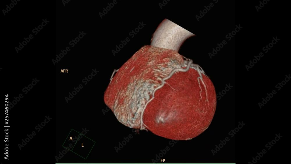 Poster cta coronary artery 3d rendering image turn around on the screen. computed tomographic angiography.
