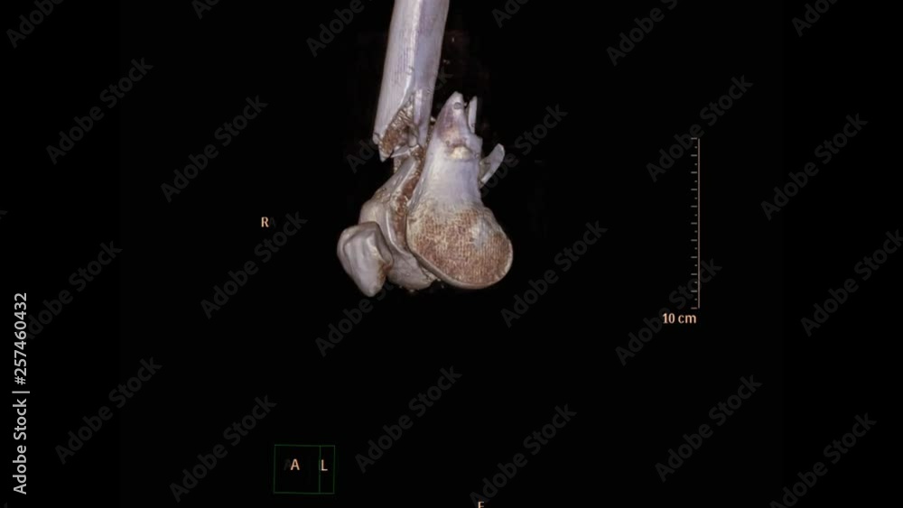 Poster ct scan of left knee 3d rendering image showing comminuted fracture of distal femur bone.