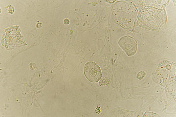 Epithelial cells with bacteria in patient urine, urinary tract infections, analyze by microscope