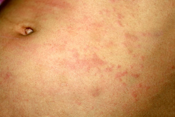Fototapeta premium Pink lichen on the skin of the abdomen. Psoriasis, dermatitis, eczema, urticaria, allergies.