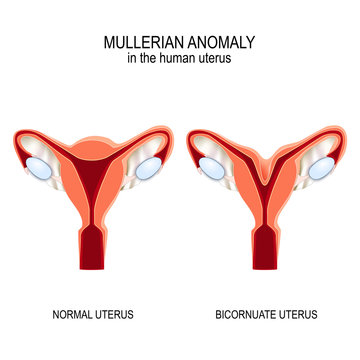 Normal womb and Bicornuate uterus.