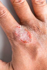 Hand With Atopic Dermatitis Eczema Psoriasis Vulgaris