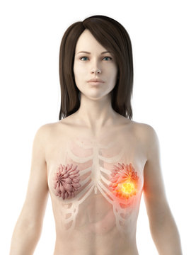 3d rendered medically accurate illustration of a womans breast cancer