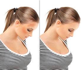 Dark spots, freckles,hyperpigmentation(melasma or chloasma)