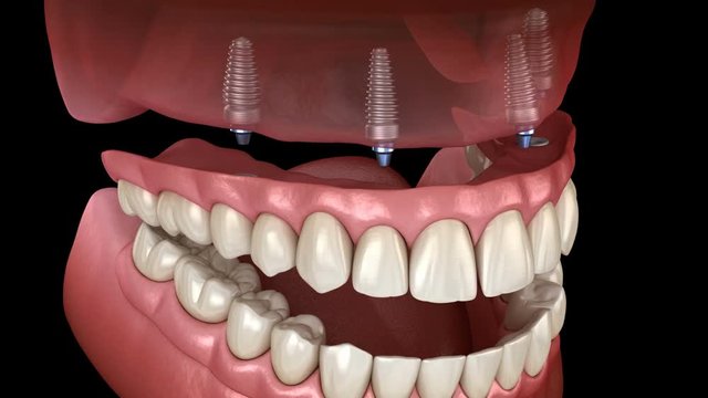 Maxillary prosthesis All on 4 system supported by implants. Medically accurate 3D animation of human teeth and dentures concept