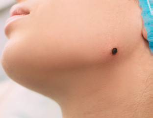 Pigment nevus on the female face, close-up. Part of series radio wave electrocoagulation remove...