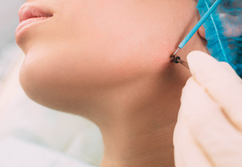 Patient getting mole removing with electrocautery and surgical tweezers on her face. Radio wave electrocoagulation remove method