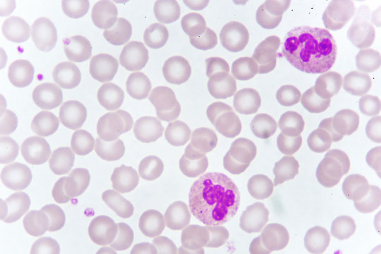 Neutrophil cell in blood smear, analyze by microscope