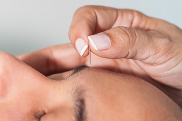 Doctor performing facial acupuncture on a young male patient