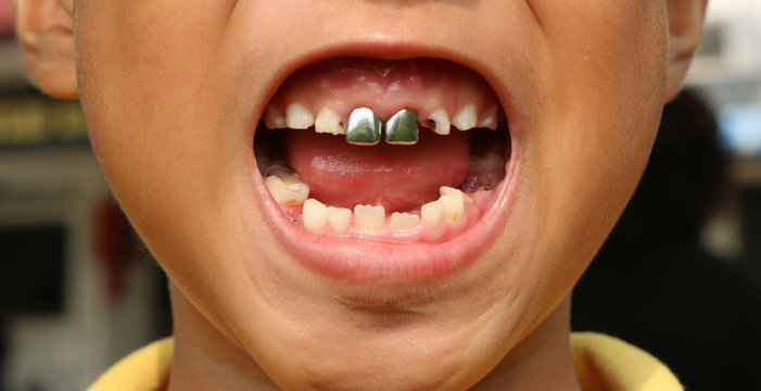 silver teeth caps children