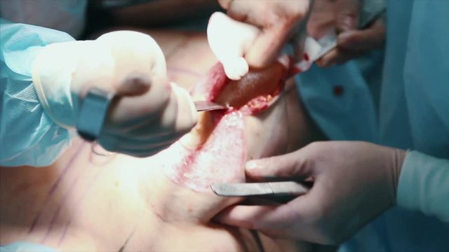 Breast implant. Removal of a malignant tumor of the mammary gland. Installation of a breast implant after removal of a cancerous tumor, close up