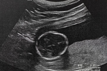 Fototapeta premium Ultrasound of baby in mother's at hospital.