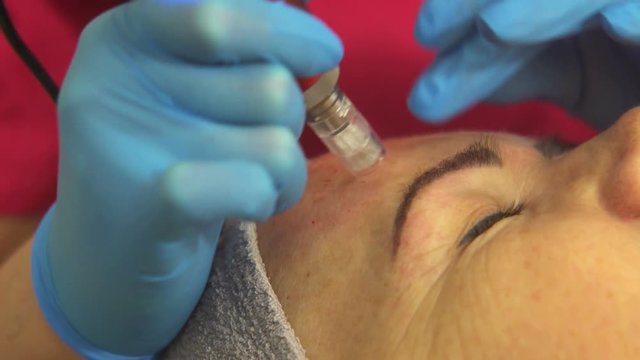Professional micro-needling mesotherapy facial procedure. Close-up. Specialist performing the treatment with a derma-pen machine.
