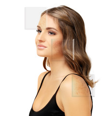 Effects of sunburn..Dark spots, freckles,hyperpigmentation(melasma or chloasma)