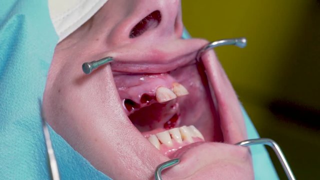 A woman getting all her teeth pulled out at the dentist