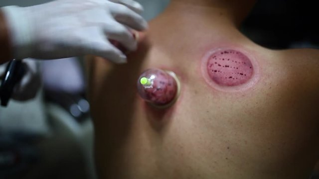 Acupuncture therapist placing cup on the back of male patient